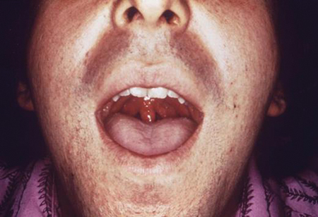 Most gonococcal pharyngeal infections are symptomatic, but infrequently acute tonsillopharyngitis is noted with mild to severe sore throat. Photo courtesy of Red Book Online.