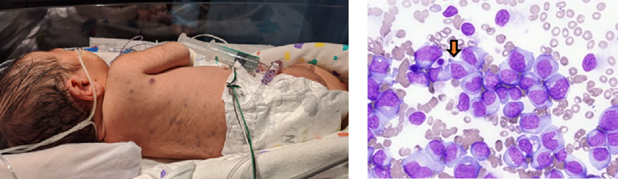 NeoQuest April 2024: Neonate with a Rash | NeoReviews | American ...