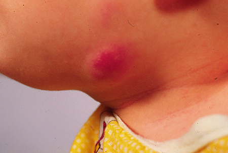 Close up of a child's face with a large red swollen area near the lower chin and neck area.