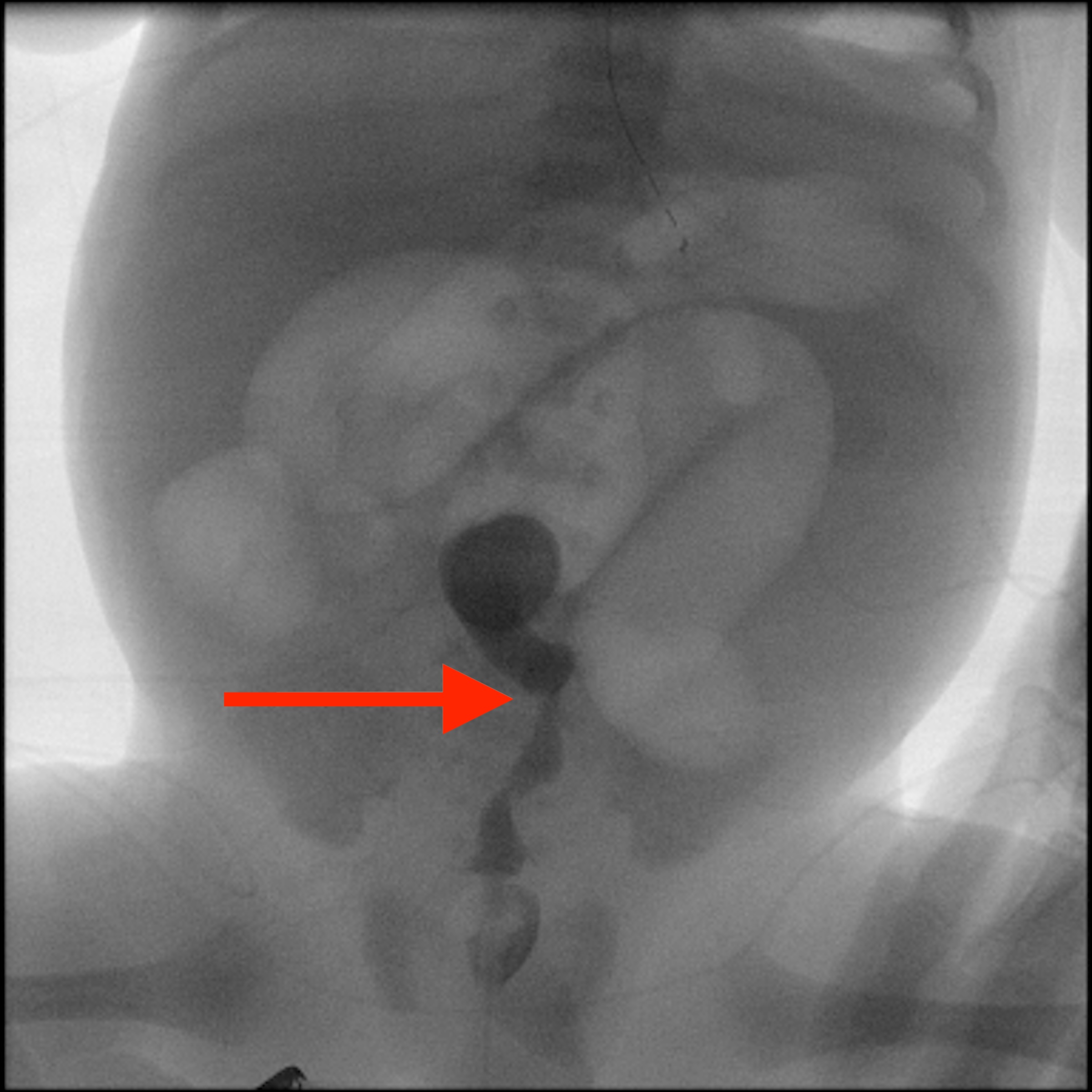 NeoQuest March 2026: A Newborn With Persistent Abdominal Distension ...