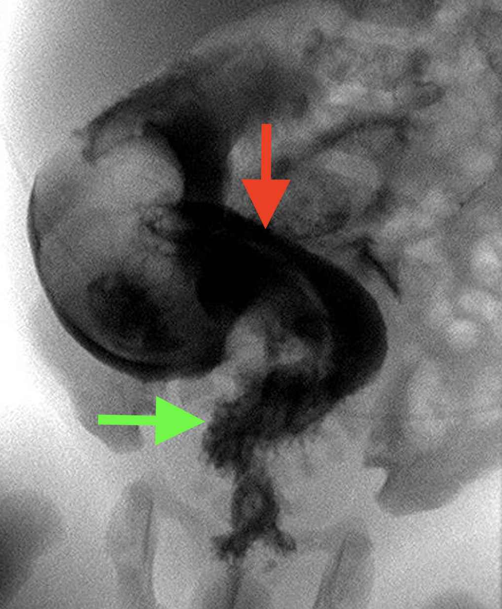NeoQuest March 2026: A Newborn With Persistent Abdominal Distension ...
