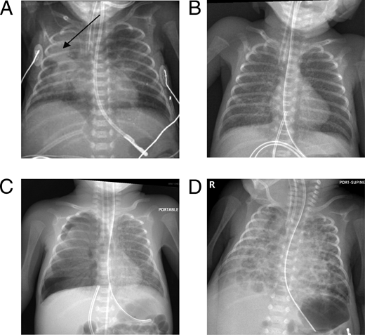 Neonatal ventilator-associated pneumonia (VAP) must be radiographically distinguished from other common radiographic findings. A lobar consolidation (A, arrow) or other radiographic evidence of neonatal VAP can coexist with or potentially be mistaken for noninfectious, common neonatal radiographic findings, such as respiratory distress syndrome (B), air leak (C), or bronchopulmonary dysplasia (D).