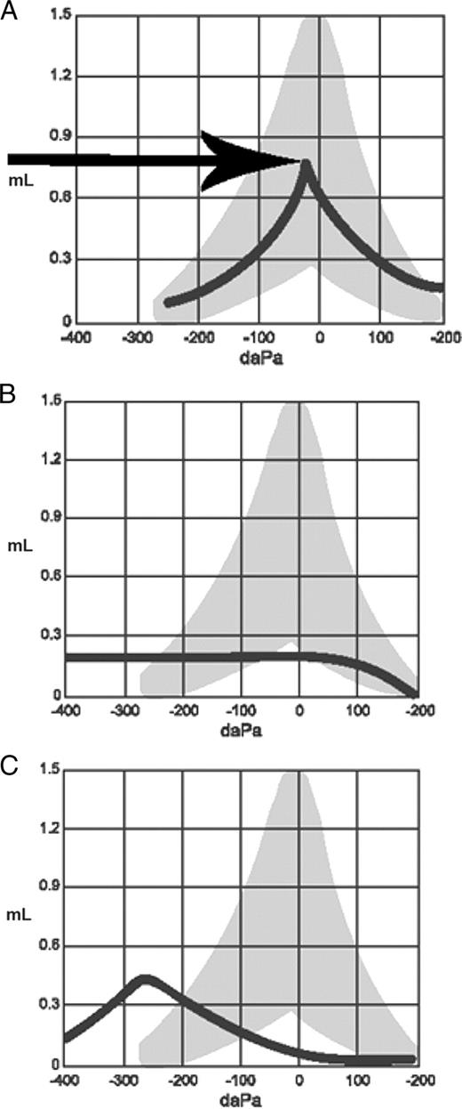 FIGURE 2. Tympanograms. Type A: normal. Type B: abnormal, needs medical attention. Type C, borderline normal; monitor; may need medical attention.