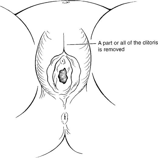 FIGURE 2. Type 1 female genital mutilation.