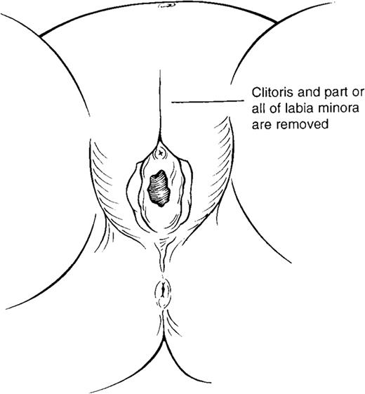 FIGURE 3. Type 2 female genital mutilation.