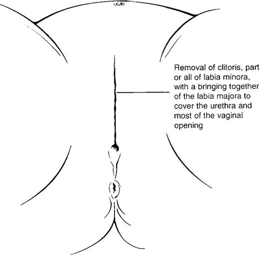 FIGURE 4. Type 3 female genital mutilation.