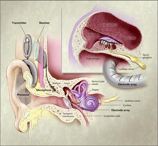 Cochlear Injection Routes Cochlear Implants in Children: Surgical Site Infections and Prevention ...