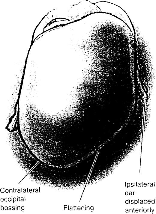 Positional Molding Prevention and Management of Positional Skull Deformities in Infants ...