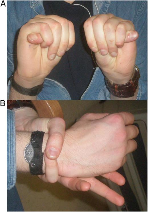 FIGURE 4. (A) Positive thumb sign with the thumbnail extending past the ulnar side of the hand and (B) positive wrist sign with the overlap of the nail beds of the thumb and fifth finger.