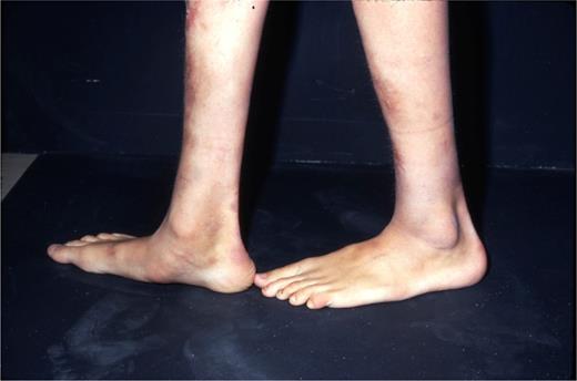 FIGURE 5. Elongated feet with collapse of the medial arch resulting in pes planus.