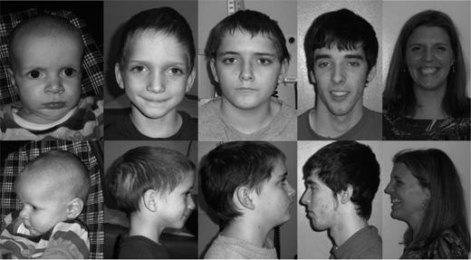 FIGURE 6. Facial features of Marfan syndrome are highly variable, ranging from subtle findings to more “classic” facial features. Photo consents for publication on file.
