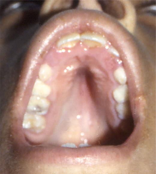 FIGURE 7. High arched (“steepled”) palate.