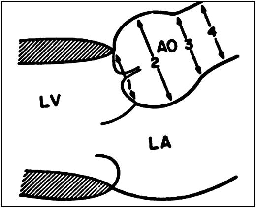 FIGURE 8. Dilation at the level of the aortic root as seen in Marfan syndrome. 1, aortic valve annulus; 2, aortic root (sinuses of Valsalva); 3, sinotubular junction; 4, ascending aorta; AO, aorta; LA, left atrium; LV, left ventricle. Rights to be retained by author (B.T.T.).