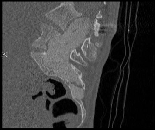 FIGURE 9. Dural ectasia of the lumbar spinal canal. MRI appearance of the dilated dural sac, which can erode the bone and entrap nerves.