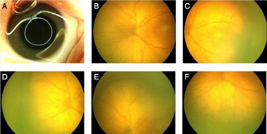FIGURE 1. ROP standard image set (right eye). A, Right anterior segment-iris; B, right disk; C, right fundus temporal (right); D, right fundus nasal; E, right fundus superior; and F, right fundus inferior.