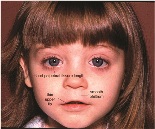 Child presenting with the 3 diagnostic facial features of FAS: (1) short palpebral fissure lengths, (2) smooth philtrum (Rank 4 or 5 on the Lip-Philtrum Guide), and (3) thin upper lip (Rank 4 or 5 on the Lip-Philtrum Guide). Legend written by Susan Astley, PhD. © 2015, Susan Astley PhD, University of Washington.