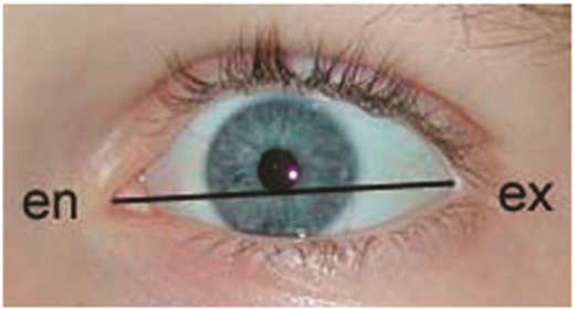 The palpebral fissure length is defined by the distance between the endocanthion (en) and exocanthion (ex) landmarks. Legend written by Susan Astley, PhD. © 2015, Susan Astley PhD, University of Washington.