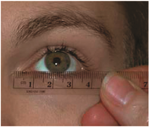 The palpebral fissure length (the distance from the inner corner to outer corner of the eye) being measured with a small plastic ruler. Legend written by Susan Astley, PhD. © 2015, Susan Astley PhD, University of Washington.