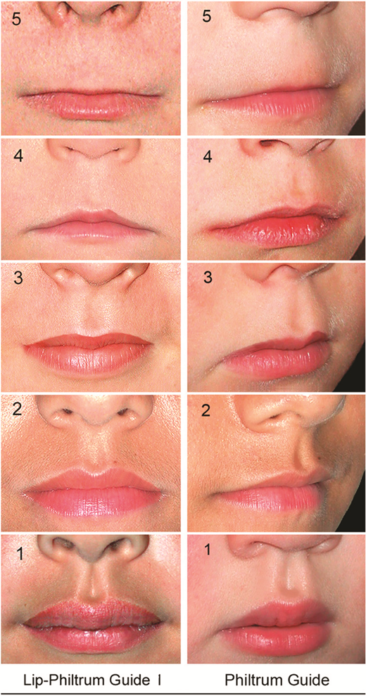 Lip-Philtrum Guide 1 is one of two Guides (see Fig 4B) used to rank upper lip thinness and philtrum smoothness. The philtrum is the vertical groove between the nose and upper lip. The guide reflects the full range of lip thickness and philtrum depth observed among Caucasians with Rank 3 representing the population mean. Ranks 4 and 5 reflect the thin lip and smooth philtrum that characterize the FAS facial phenotype. Guide 1 is used for Caucasians and all other races with lips like Caucasians. This guide is available from fasdpn.org as a free digital image for use on smartphones. © 2015 Susan Astley, PhD, University of Washington. Legend written by Susan Astley, PhD.