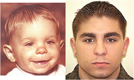 Young man presenting with the 3 facial features of FAS (small eyes, smooth philtrum, and thin upperlip) at 2 years of age and 20 years of age. Legend written by Susan Astley, PhD. © 2015, Susan Astley PhD, University of Washington.