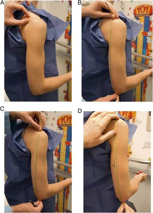 FIGURE 2. Determination of proper BP cuff size.95 A, Marking spine extending from acromion process. B, Correct tape placement for upper arm length. C, Incorrect tape placement for upper arm length. D, Marking upper arm length midpoint.