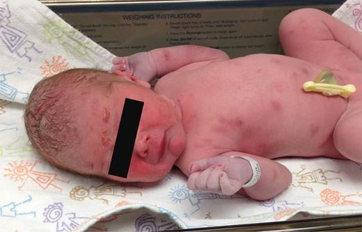 FIGURE 1. Patient on first day of life. Coalescing erythematous vesicles are seen on the face, and dull gray and erythematous patches and plaques are seen on the body and extremities. The mucous membranes, hands, and the soles of the feet are spared.