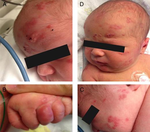 FIGURE 2. A, Lesions on the first day of life. B, New lesions on fingers on the fourth day of life. C, New lesions on cheeks on the fourth day of life. D, Lesions on the fifth day of life. The forehead vesicles became less raised and less erythematous. A few new lesions appeared on the scalp.