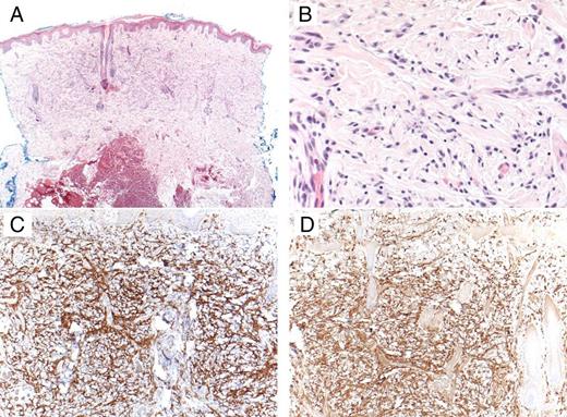 FIGURE 3. A punch biopsy showed an infiltrate filling the upper third of the dermis. The infiltrate was composed of monomorphic spindled and cuboidal cells with small central nuclei and lightly granular amphophilic cytoplasm. A, Hematoxylin and eosin stain (original magnification ×4). B, Hematoxylin and eosin stain (original magnification ×40). C, Mast cell marker CD117 (original magnification ×10). D, Mast cell tryptase (original magnification ×10).