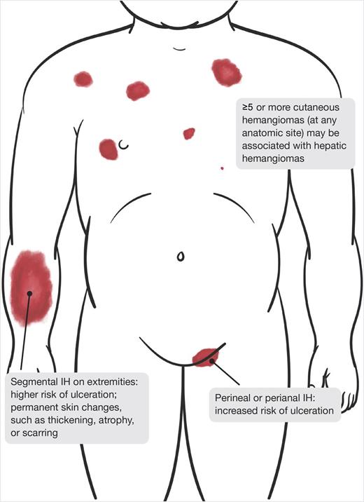 clinical-practice-guideline-for-the-management-of-infantile-hemangiomas