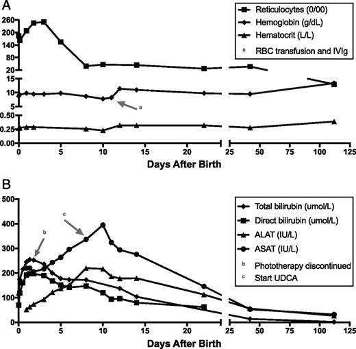 Severe Fetal Hemolysis and Cholestasis Due to HighTiter Maternal IgG