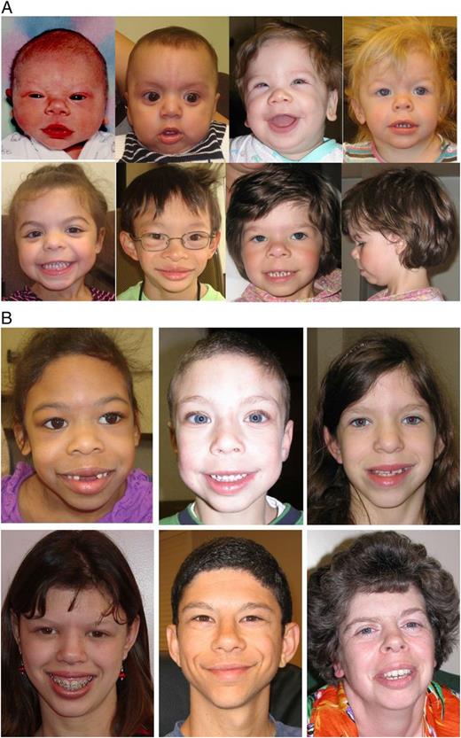 FIGURE 1. A, Infants and young children with WS. Top row (left to right) is as follows: newborn boy, 6-month-old boy, 9-month-old boy, and 1-year-old girl. Bottom row (left to right) is as follows: 2-year-old girl, 4-year-old boy, and 4-year-old girl (front view and profile). B, Children and adults with WS. Top row (left to right) is as follows: 5-year-old girl, 6-year-old boy, and 10-year-old-girl. Bottom row (left to right) is as follows: 14-year-old girl, 23-year-old man, and 34-year-old woman.