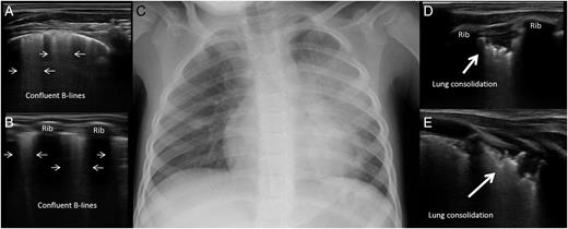 FIGURE 1. A and B, Multiple confluent B-lines (thin arrows). C, Chest radiography with left upper lobe consolidation and right central ground-glass opacities. D and E, A lung consolidation (thick arrows) at LUS.