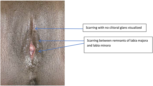 Diagnosis, Management, and Treatment of Female Genital Mutilation or ...