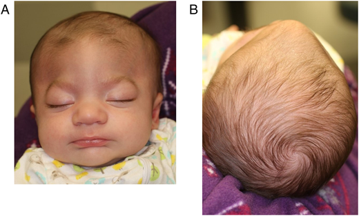 Metopic Ridge Normal Vs Metopic Ridge Identifying the Misshapen Head: Craniosynostosis and Related Disorders ...