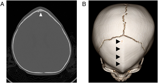 Metopic Ridge Normal Vs Metopic Ridge Identifying the Misshapen Head: Craniosynostosis and Related Disorders ...