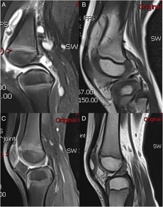 Knee Joint Swelling at Presentation: A Case of Pediatric Crohn Disease ...