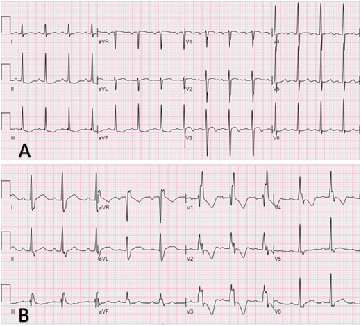 ECG findings in a 9-year-old boy. A, Initial 12-lead ECG on presentation revealing normal sinus rhythm with narrow QRS complexes. B, Twelve-lead ECG on day 3 of hospitalization revealing first-degree AVB (PR of 200 milliseconds) with RBBB.
