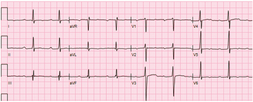 Twelve-lead ECG revealing significant first-degree AVB with a PR interval of 302 milliseconds and nonspecific T wave abnormalities in a 12-year-old boy.