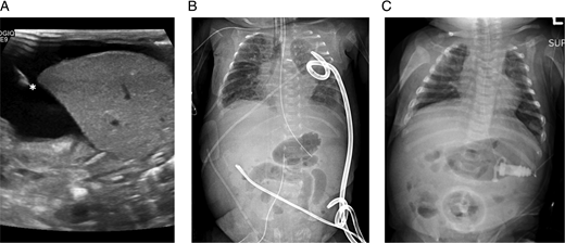 Use of Propranolol in the Treatment of Chylous Effusions in Infants ...