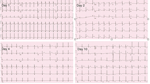 FIGURE 1. ECG in a 17-year-old patient with myocarditis after COVID-19 vaccination showing diffuse ST-segment elevation (days 1 and 2) and T-wave inversion (days 4 and 10).
