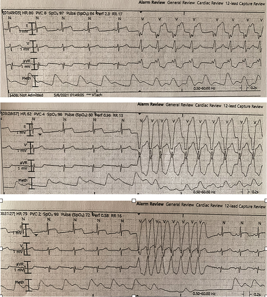 FIGURE 2. Strips from a telemetry unit showing multiple episodes of nonsustained ventricular tachycardia in a 16-year-old patient with myocarditis after COVID-19 vaccination. HR, heart rate; PVC, premature ventricular contraction; SpO2, pulse oxygen saturation; RR, respiratory rate.