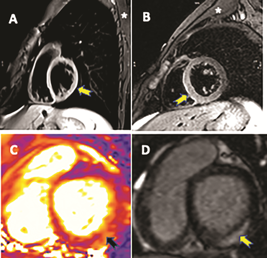 FIGURE 3. CMR examples of myocardial edema in the C-VAM cohort. A and B, T2-weighted images show high signal intensity in the myocardium (yellow arrow) compared with the skeletal muscle (*) in 2 patients. C and D, T2 mapping image demonstrates an area of elevated T2 (black arrow) in subepicardial and midmyocardial regions (C) corresponding to an area of LGE (yellow arrow) (D).