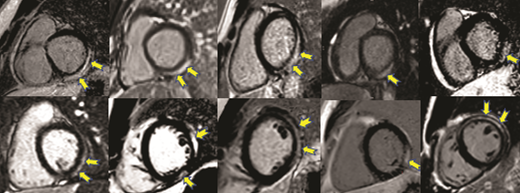 FIGURE 4. CMR examples illustrating LGE in the C-VAM cohort (short-axis view). The pattern of LGE is notably similar across all patients, with a subepicardial distribution along the lateral, inferolateral, and inferior walls in the basal and midmyocardium of the left ventricle (yellow arrows).