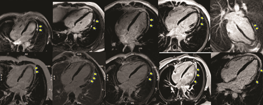 FIGURE 5. CMR examples illustrating LGE in the C-VAM cohort (4-chamber view). The pattern of LGE is notably similar across all patients, with enhancement in a subepicardial and midmyocardial pattern noted along the lateral and inferior walls (yellow arrows).