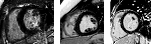 FIGURE 6. A–C, CMR images in 3 children hospitalized for MIS-C revealing trivial, focal subepicardial or midmyocardial LGE (white arrows). All 3 patients presented with at least moderate ventricular dysfunction and required inotropic support, including one needing ECMO (B).
