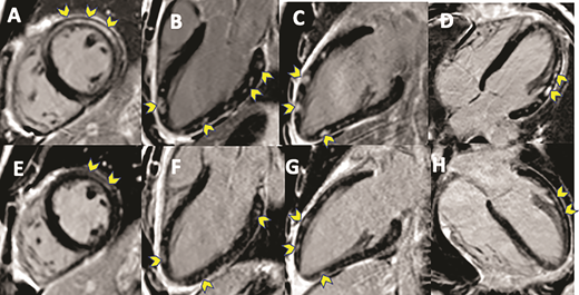 FIGURE 7. A–E, CMR in a patient with C-VAM at the time of diagnosis (A–D) and 8 weeks post diagnosis (E–H). There is notable persistence of myocardial LGE (yellow arrows), with mild improvement.