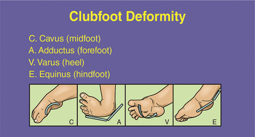 Structural Clubfoot Diagnosis and Treatment of Idiopathic Congenital Clubfoot | Pediatrics ...