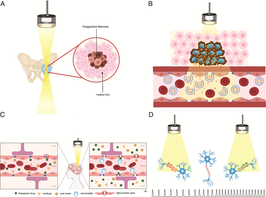 A, Thermal ablation. As the HIFU beam (yellow) focuses on a targeted anatomic lesion, the area is heated to a threshold temperature causing coagulative necrosis. The nontargeted healthy cells remain intact immediately adjacent to the ablated, necrotic cells with a narrow zone of transition. B, Targeted Drug Delivery. The focused ultrasound beam (yellow) enhances drug delivery by releasing medications from thermosensitive liposomes only within the tumor vessels, sparing surrounding and distant normal cells from potential drug toxicity. C, Blood Brain Barrier Opening. The focused ultrasound beam opens the BBB in a target location by oscillating the injected intravenous microbubbles that exert mechanical pressure on the endothelium and subsequently widen the tight junctions to allow molecules such as drugs, viral vectors, and antibodies to pass into the brain. D, Neuromodulation. With various parameters of the LIFU beam (yellow), neuronal signal may be suppressed (red axons) or stimulated (green axons).