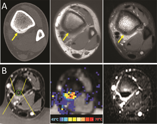 Osteoid osteoma. 17-year-old boy with left leg pain worse at night and temporarily relieved with Ibuprofen. No history of trauma. A, Diagnostic. Axial CT (left) and MRI (middle and right) images demonstrate the central nidus and periosteal reaction along the tibia (arrows). B, Focused ultrasound. MRI planning image (left) with beam path (yellow lines) focused on the nidus (green circle). Elevated temperature in nidus (yellow/orange) during sonication on MR thermometry image (center). Posttreatment postcontrast image (right) demonstrates nonperfusion (arrow) of the nidus.