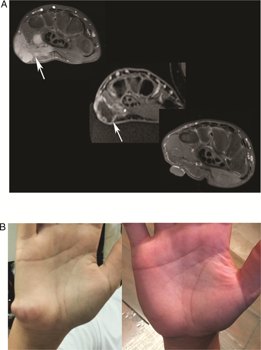 Desmoid tumor. A 14-year-old boy with lump on palm of right hand unable to play lacrosse. A, Axial MRI 6 months before HIFU treatment (upper left) demonstrates enhancing desmoid (arrow). Immediate post treatment scan (middle) shows nonperfusion and ablation with some surrounding enhancement (arrow). Twelve months after treatment (lower right) confirms no tumor or residual enhancement. B, Picture of hand with mass before (left) and 12 months after (right) HIFU procedure with complete resolution. Courtesy of Pejman Ghanouni, MD, PhD. 